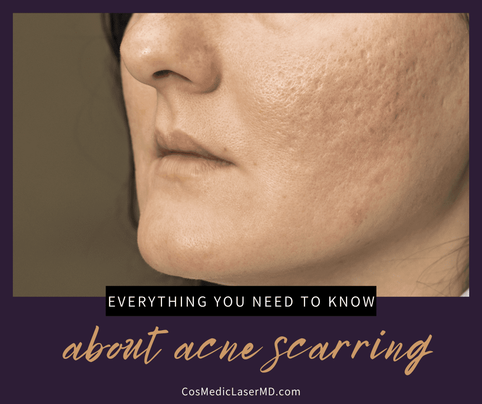 Acne Scars: Everything You Need to Know