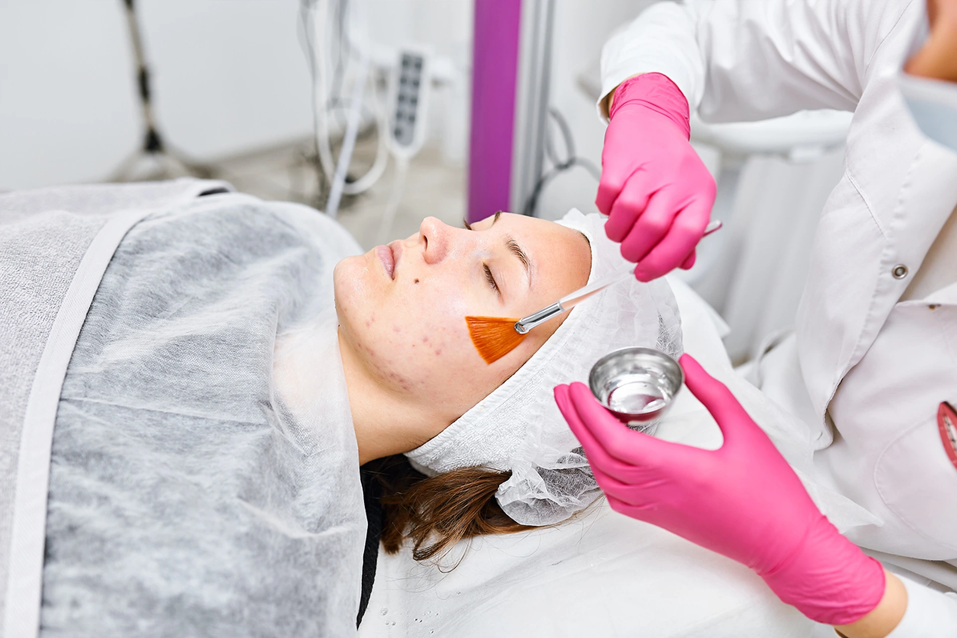 Chemical Peels for Acne: Fast-Track to Clear Skin