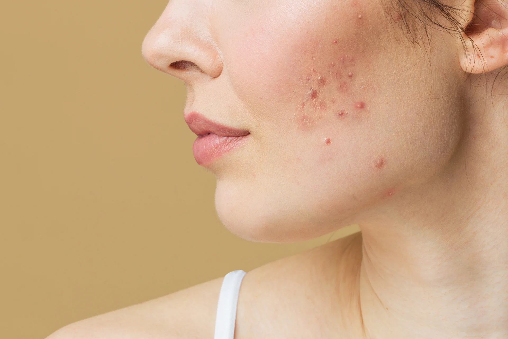 How to Treat Breakouts After a Chemical Peel