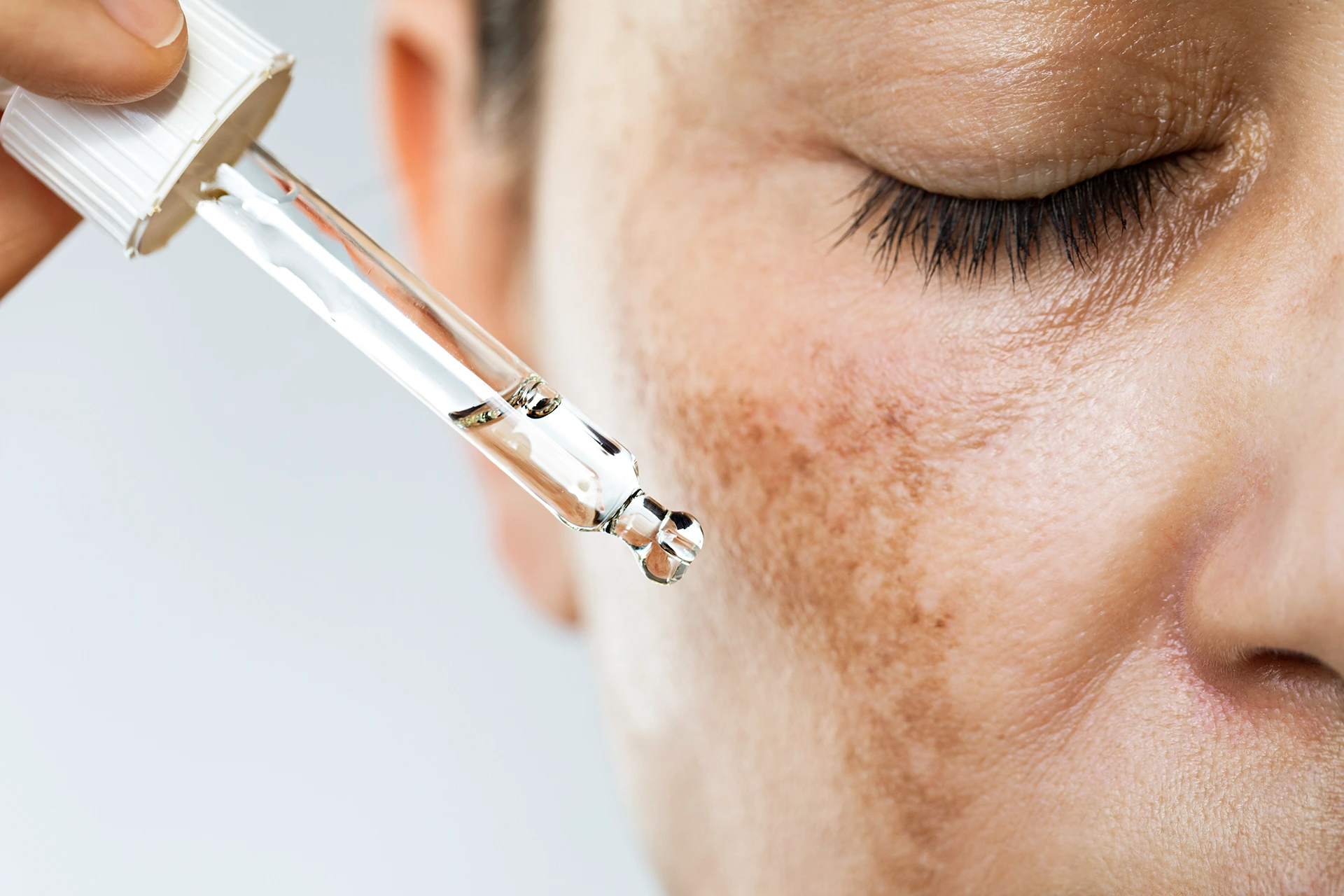 The Best Chemical Peels for Fading Dark Spots