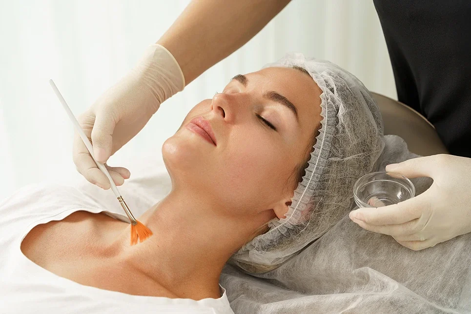 Benefits of Light Chemical Peels