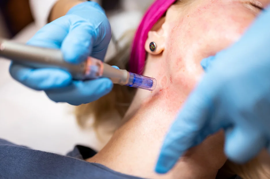 The 14-Day Ann Arbor Wedding Microneedling Timeline