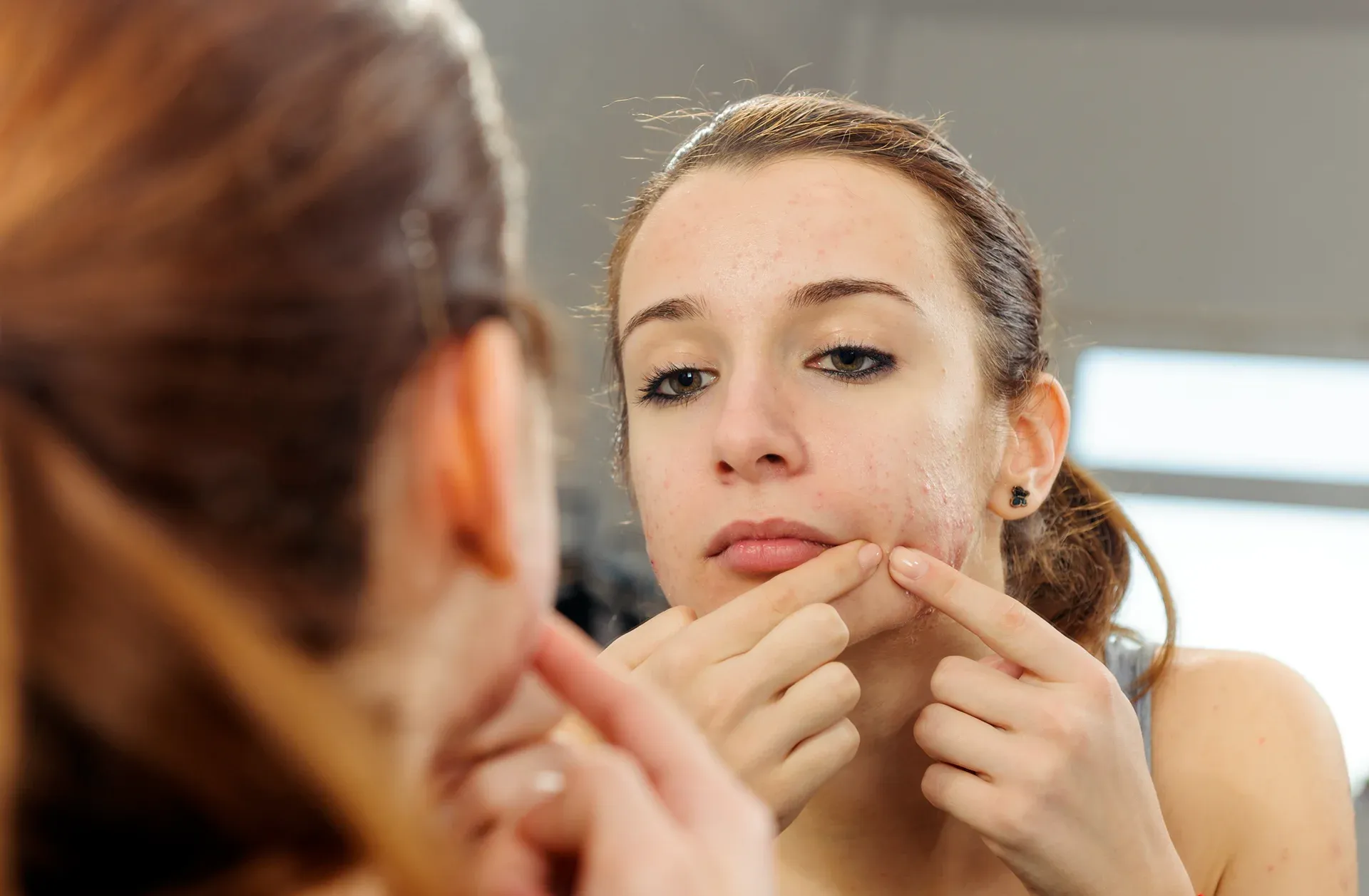 Clear Skin for the Classroom: Teen Acne Solutions in Dexter