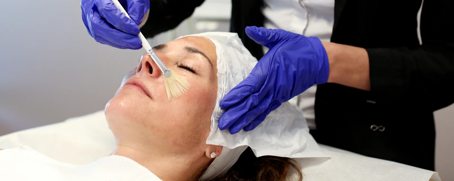 Chemical Peels