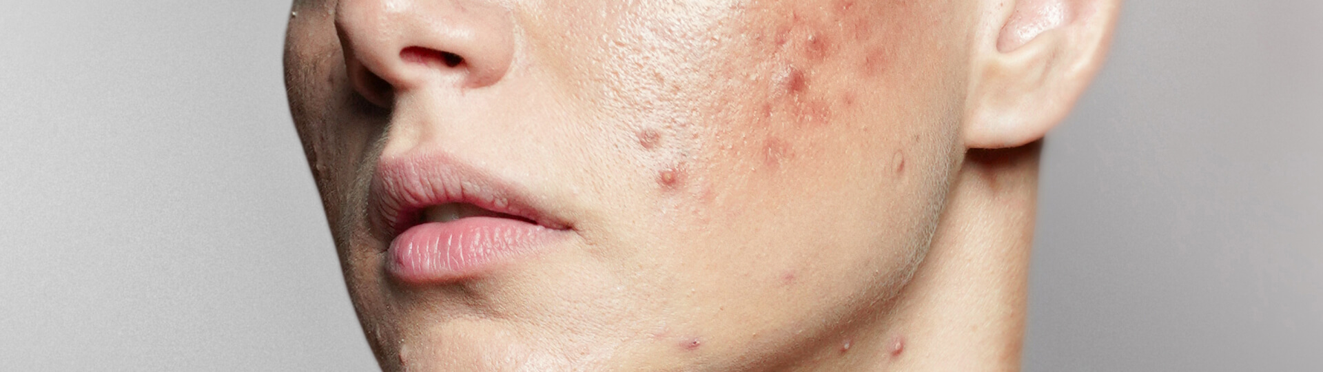 Acne Scars