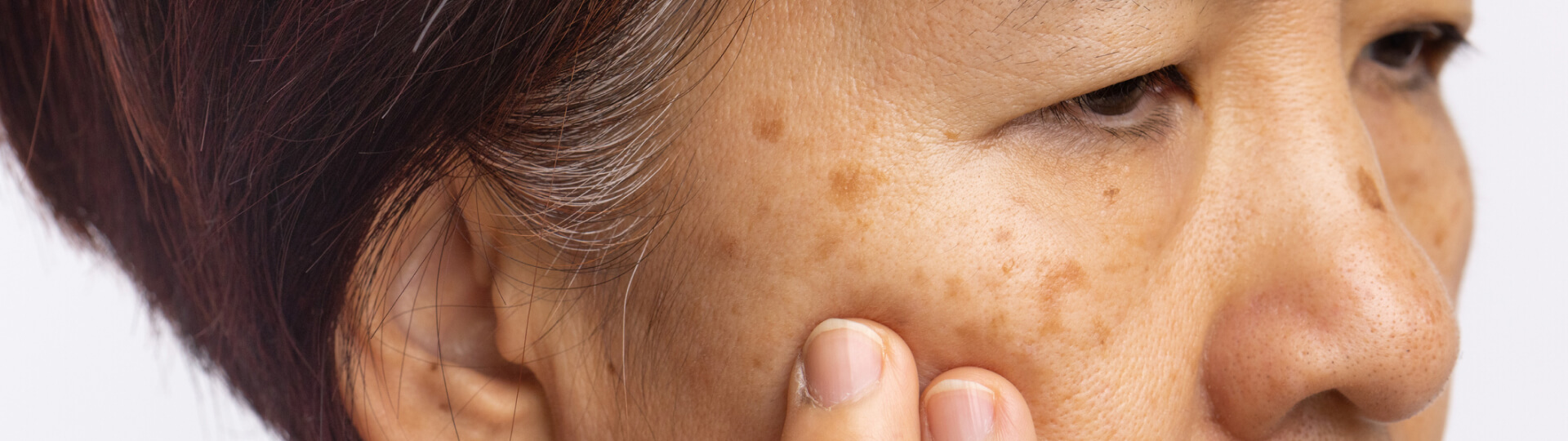 Melasma
