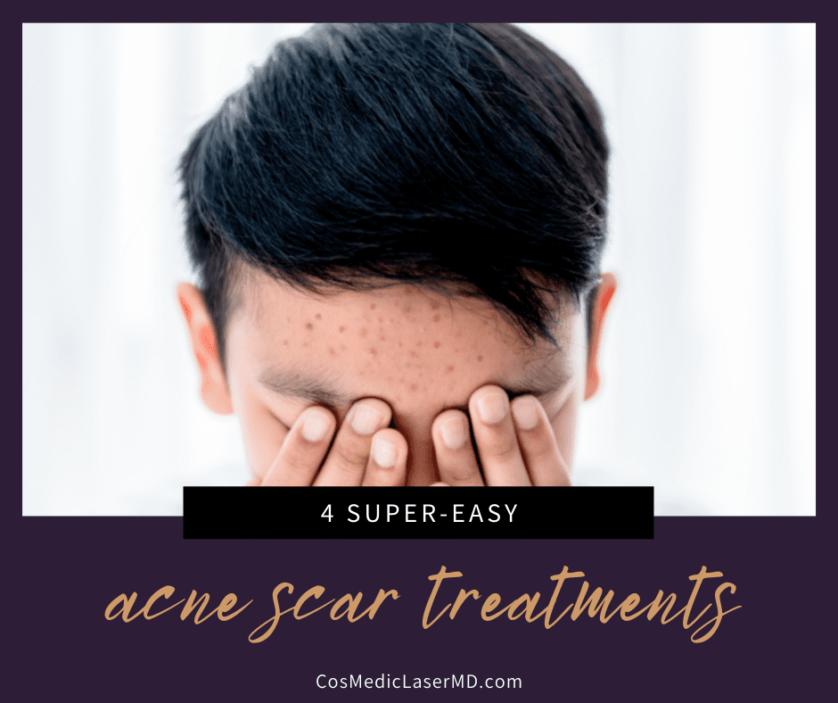 4 Easy Acne Scar Treatments in Ann Arbor - CosMedic Laser MD for Acne Scarring