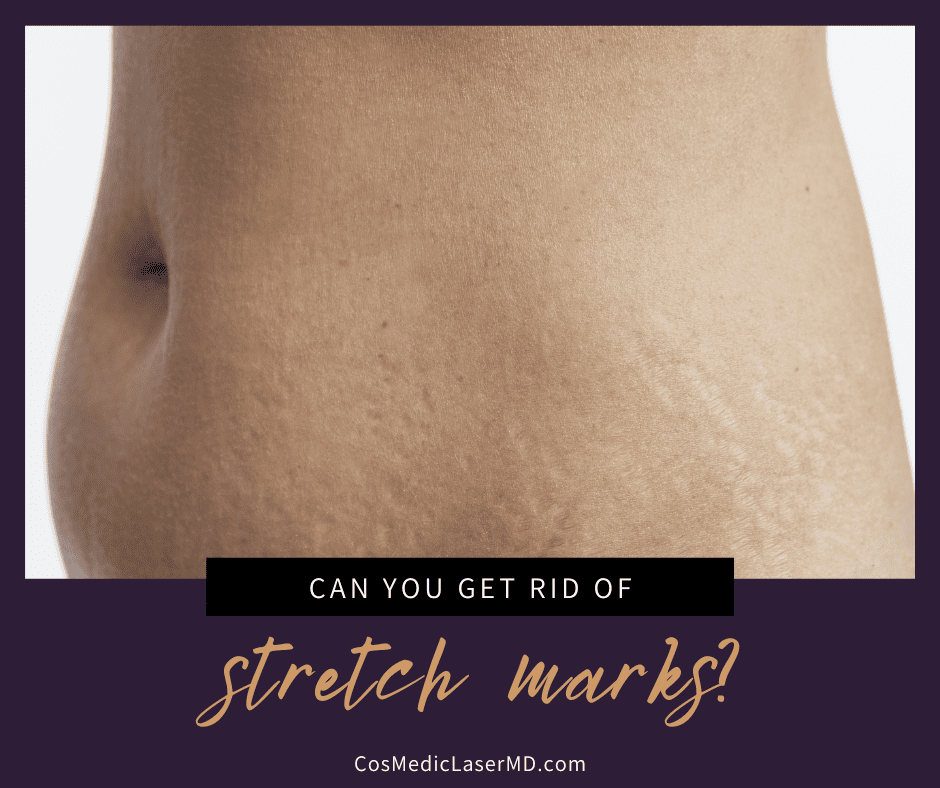 How to Get Rid of Stretch Marks Once and for All