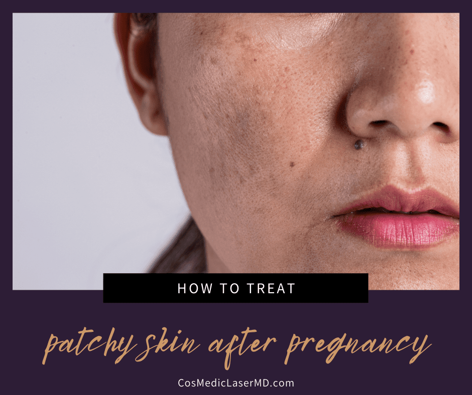 How to Treat Patchy Skin After Pregnancy