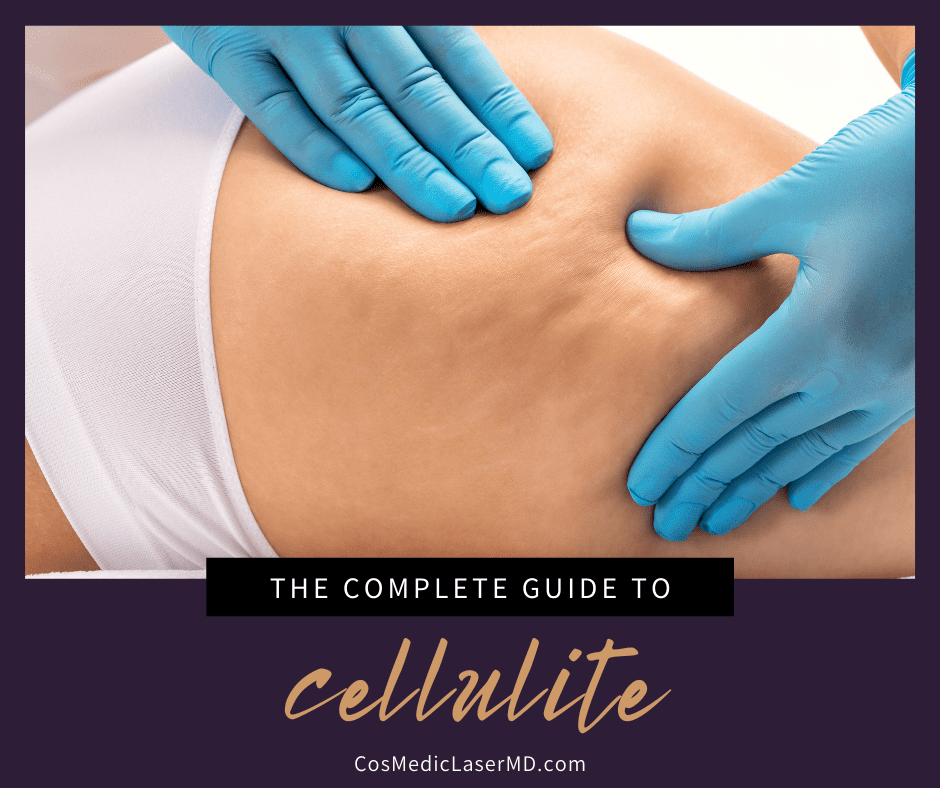 The Complete Guide to Cellulite - How to Get Rid of Cellulite in Ann Arbor