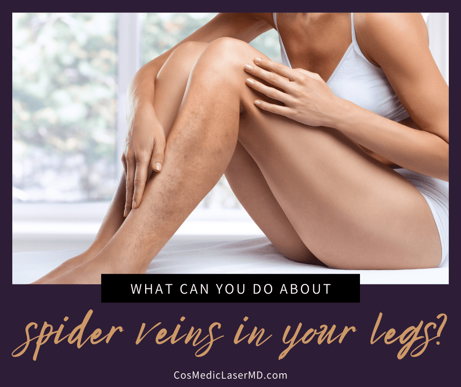 What Can You Do About Spider Veins in Your Legs?