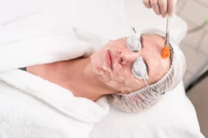 Chemical Peel for Acne Scars