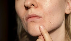 face itchy after dermaplaning